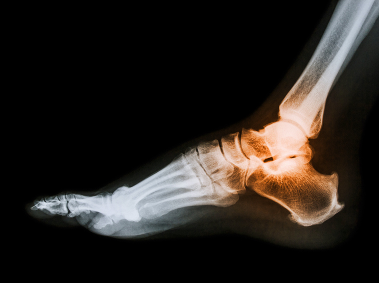 Sprunggelenksarthrose Ankle osteoarthritis